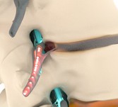 Subluxation